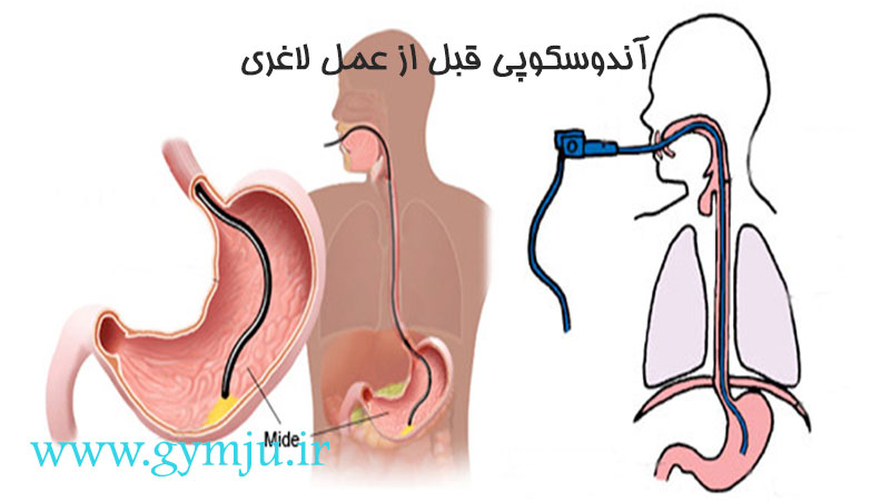 آندوسکوپی قبل از عمل لاغری