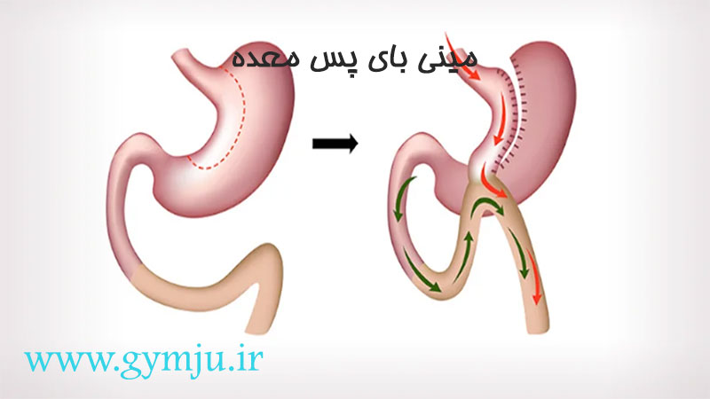 مینی بای پس معده