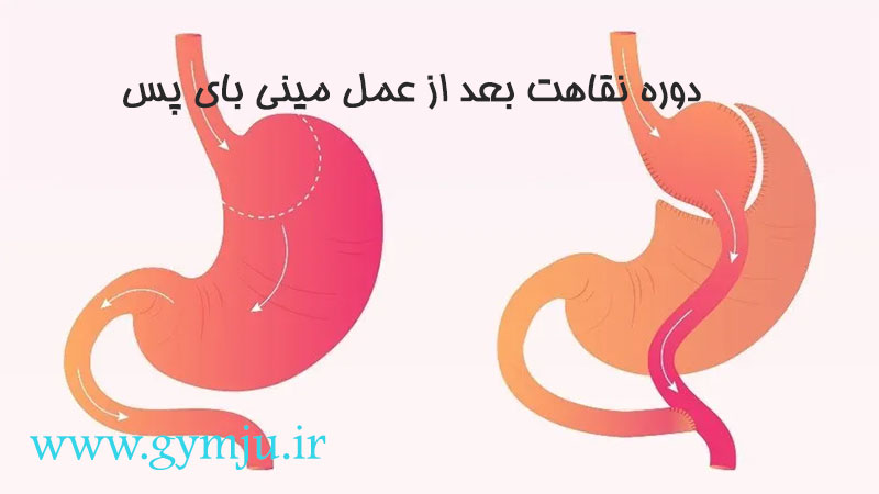 دوره نقاهت بعد از عمل مینی بای پس