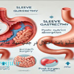 آیا عمل اسلیو باعث اختلال در جذب مواد غذایی می شود