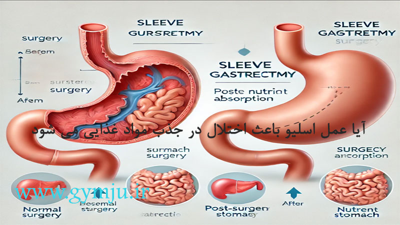 آیا عمل اسلیو باعث اختلال در جذب مواد غذایی می شود