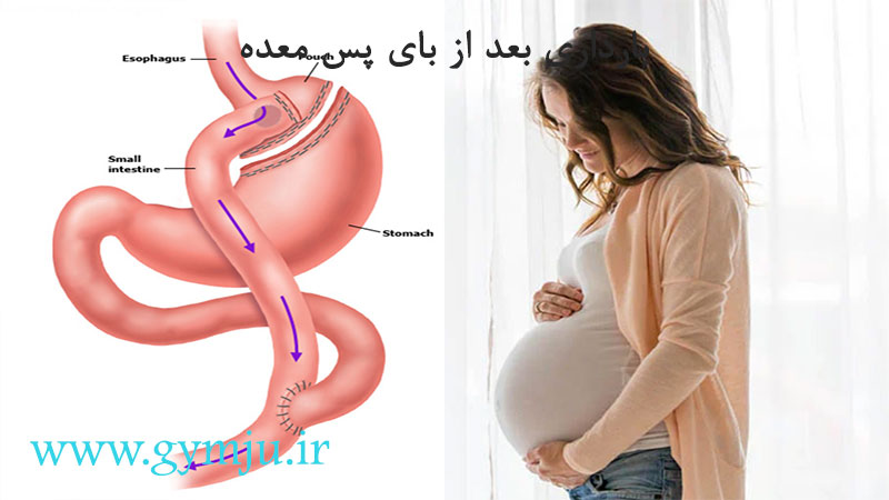 بارداری بعد از بای پس معده